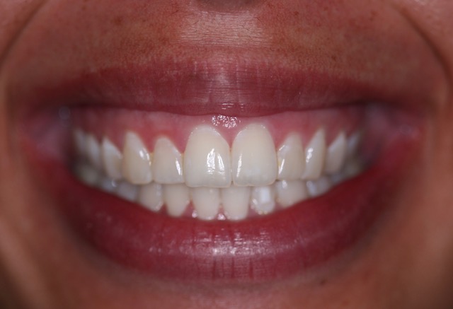 A New Technique to Treat 'Gummy Smile and Discolored Gums ...