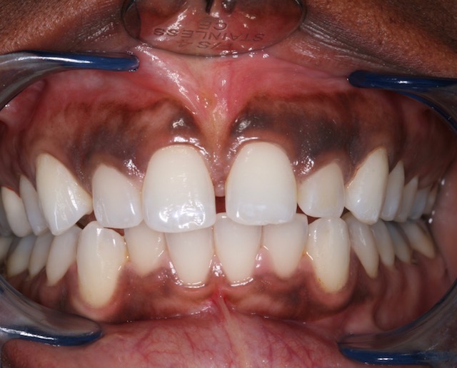 A New Technique to Treat 'Gummy Smile and Discolored Gums ...